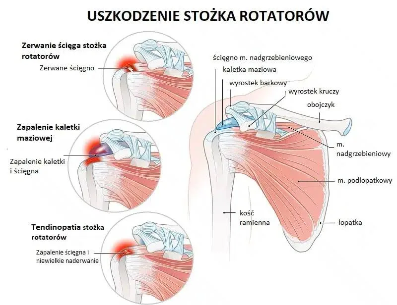 Ból barku przy podnoszeniu ręki – stożek rotatorów?