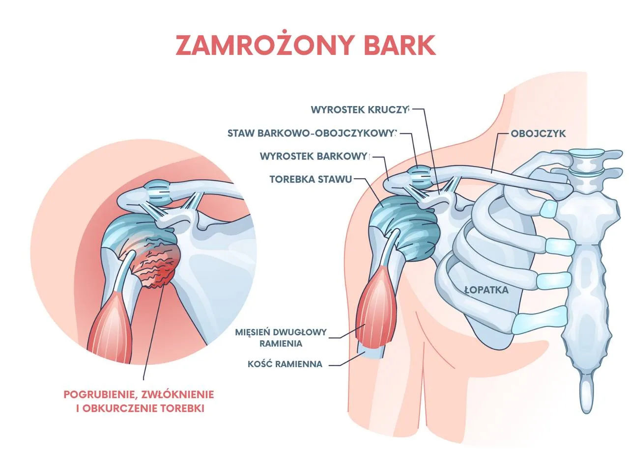 Ból barku przy podnoszeniu ręki – stożek rotatorów?