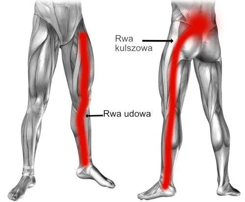 Ból kręgosłupa lędźwiowego – rwa i korzonki