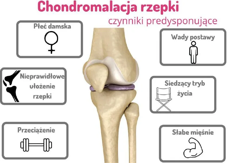 Chondromalacja Rzepki – objawy i postępowanie