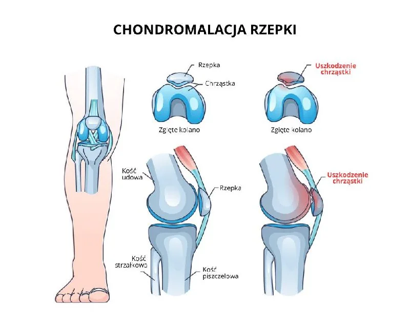 Chondromalacja Rzepki – objawy i postępowanie