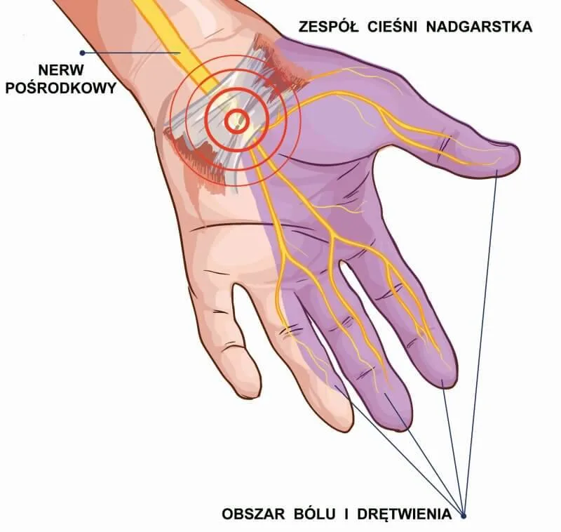 Drętwienie dłoni i ból nadgarstka – co oznacza?