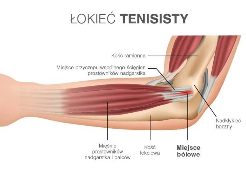 Łokieć tenisisty – skąd bierze się ból?