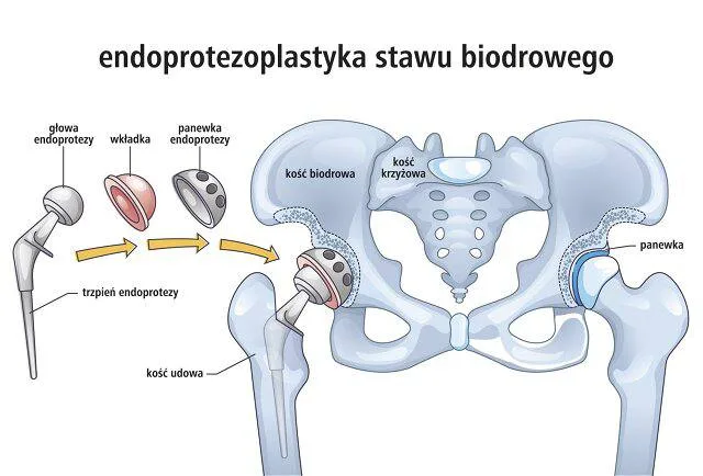 Rehabilitacja po endoprotezie biodra