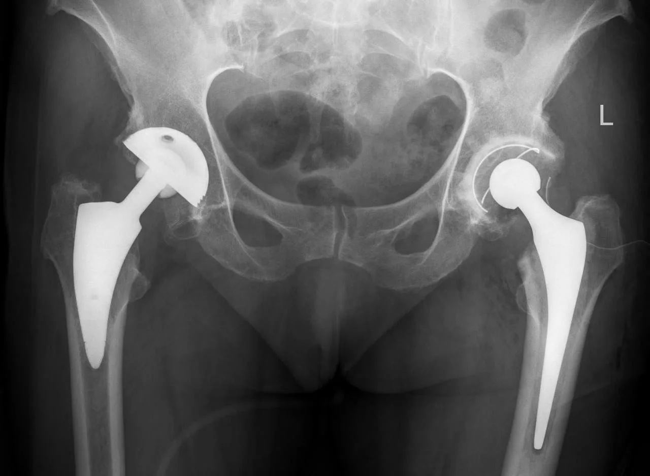 Rehabilitacja po endoprotezie biodra